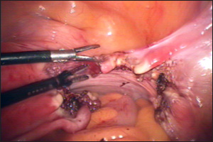 Intercourse After Laparoscopic Surgery 11